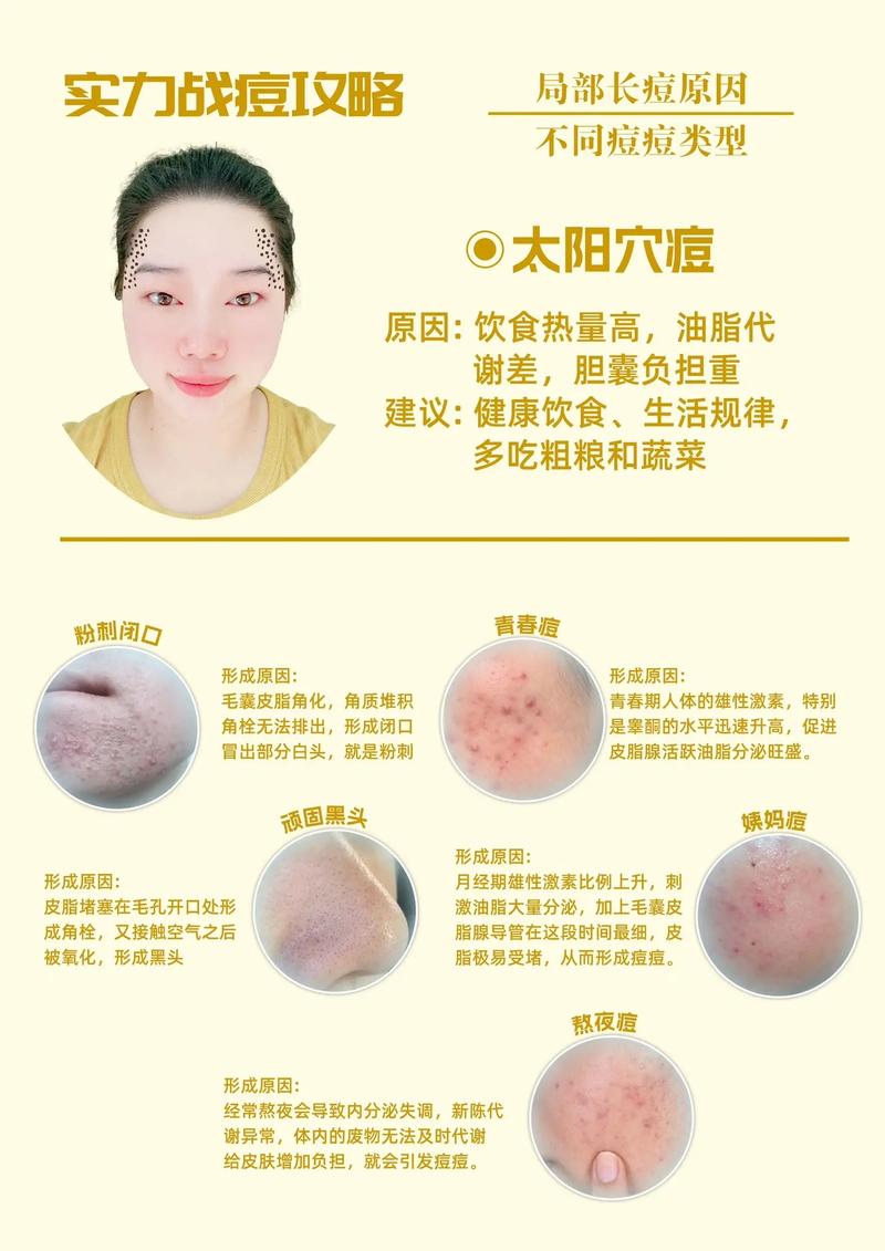 痘痘化妆新手教程（痘痘肌肤化妆步骤）