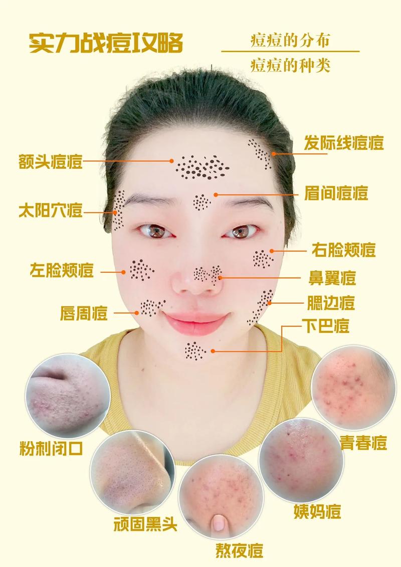 痘痘化妆新手教程(痘痘肌肤化妆步骤)-第2张图片-美妆 痘痘化妆新手教程(痘痘肌肤化妆步骤)-第2张图片-美妆