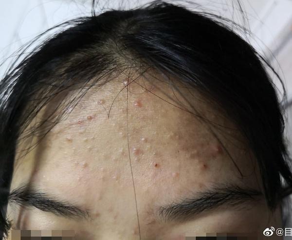 闭口怎么化妆教程淡妆修复,闭口平时怎么护理-第2张图片-美妆 闭口怎么化妆教程淡妆修复,闭口平时怎么护理-第2张图片-美妆
