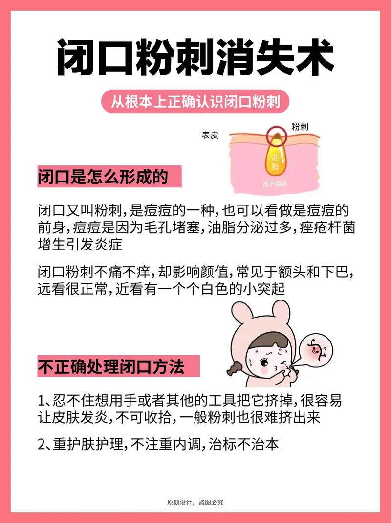 闭口怎么化妆教程淡妆修复,闭口平时怎么护理-第3张图片-美妆 闭口怎么化妆教程淡妆修复,闭口平时怎么护理-第3张图片-美妆