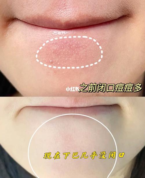闭口怎么化妆教程淡妆修复,闭口平时怎么护理-第5张图片-美妆 闭口怎么化妆教程淡妆修复,闭口平时怎么护理-第5张图片-美妆