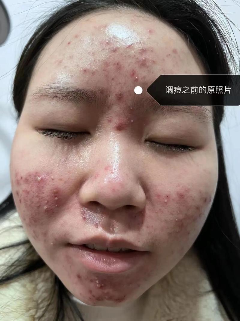 痘印化妆新手教程(有痘印怎么化妆好看简单步骤)-第4张图片-美妆 痘印化妆新手教程(有痘印怎么化妆好看简单步骤)-第4张图片-美妆