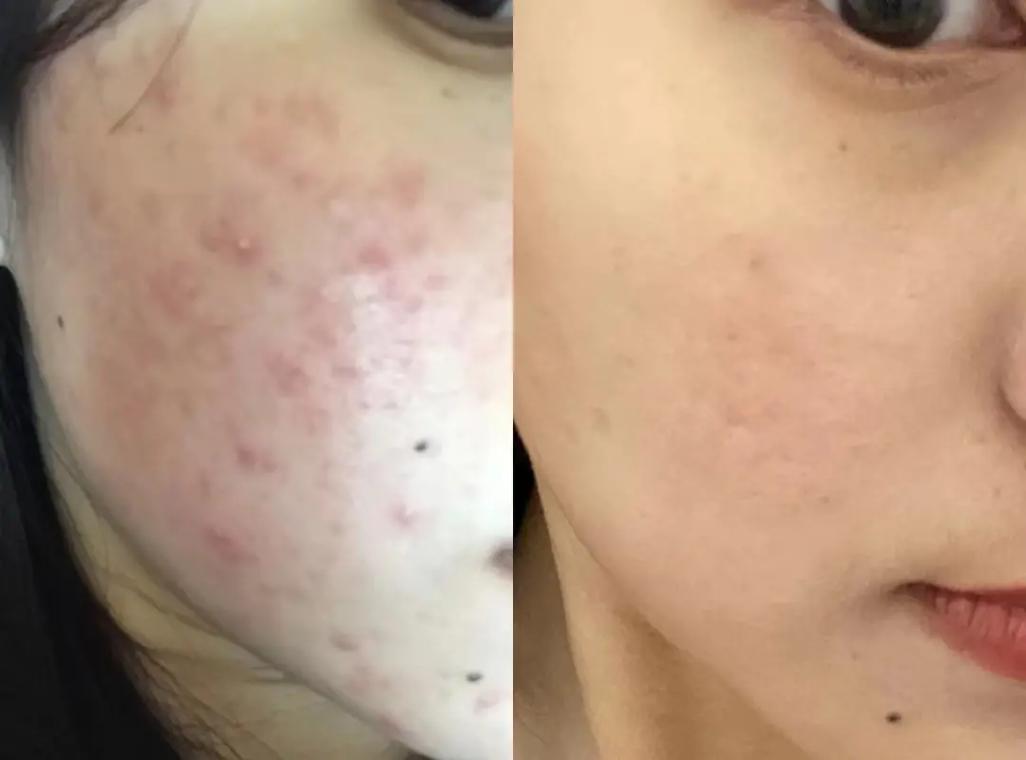 痘印化妆新手教程(有痘印怎么化妆好看简单步骤)-第6张图片-美妆 痘印化妆新手教程(有痘印怎么化妆好看简单步骤)-第6张图片-美妆