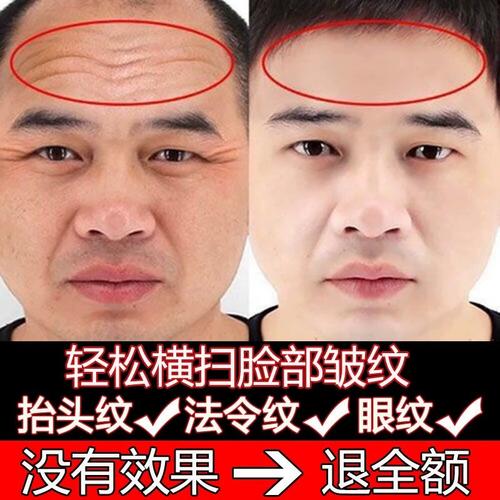 男士遮抬头纹化妆品推荐,男士抬头纹怎么处理-第1张图片-美妆