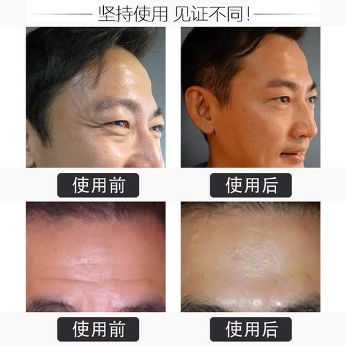 男士遮抬头纹化妆品推荐,男士抬头纹怎么处理-第6张图片-美妆