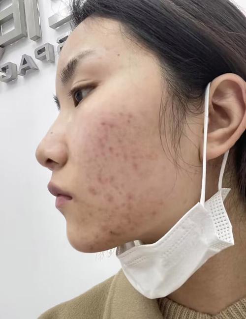 痘印脸化妆教程淡妆,痘印脸化妆教程淡妆怎么化-第2张图片-美妆 痘印脸化妆教程淡妆,痘印脸化妆教程淡妆怎么化-第2张图片-美妆