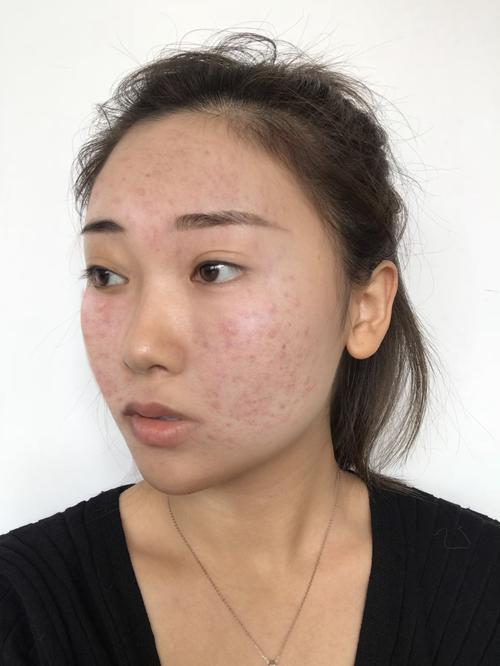 痘印脸化妆教程淡妆,痘印脸化妆教程淡妆怎么化-第5张图片-美妆 痘印脸化妆教程淡妆,痘印脸化妆教程淡妆怎么化-第5张图片-美妆