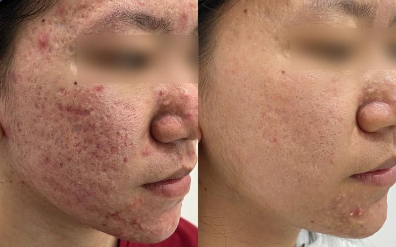 新手学化妆教程痘痘肌(新手小白学化妆)-第4张图片-美妆 新手学化妆教程痘痘肌(新手小白学化妆)-第4张图片-美妆