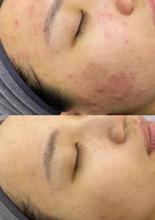 化妆新手教程痘痘肌(痘痘化妆挑战)-第5张图片-美妆 化妆新手教程痘痘肌(痘痘化妆挑战)-第5张图片-美妆