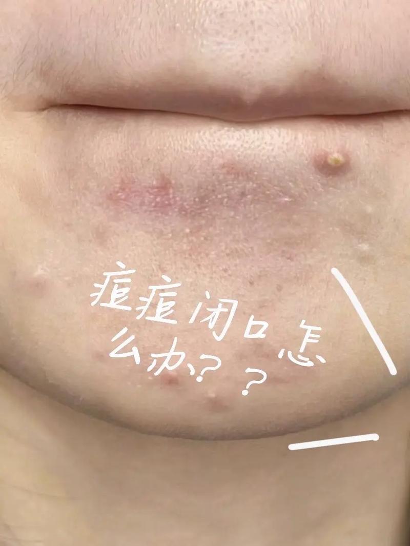 闭口新手化妆入门教程（闭口用什么化妆品最合适）-第2张图片-美妆