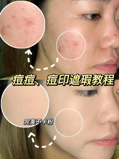 化妆遮痘痘新手教程（化妆遮痘痘的叫什么）-第3张图片-美妆