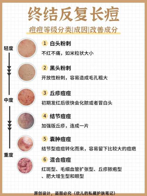 化妆遮痘痘新手教程（化妆遮痘痘的叫什么）-第4张图片-美妆
