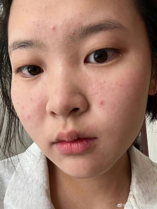 化妆遮痘痘新手教程（化妆遮痘痘的叫什么）-第7张图片-美妆